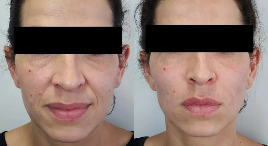 Dermal Filler Treatment Results